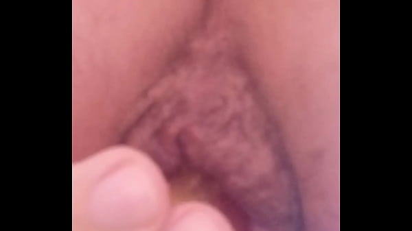 Image I irritating my hemorrhoidal rose to the point of gigantic prolapse