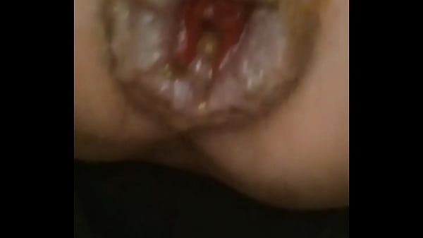 Image I jerk off my hemorrhoidal rose until it prolapses