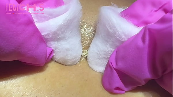 Image Extra&ccedil_&atilde_o de cravos e espinhas