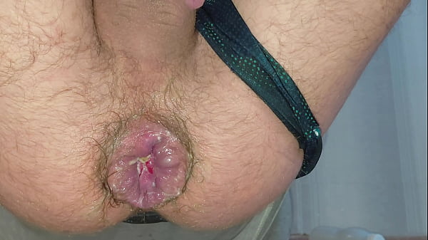 Image A stretched anus reveals a hemorrhoidal prolapse from riding a giant bottle. Amazing hardcore fisting at home.